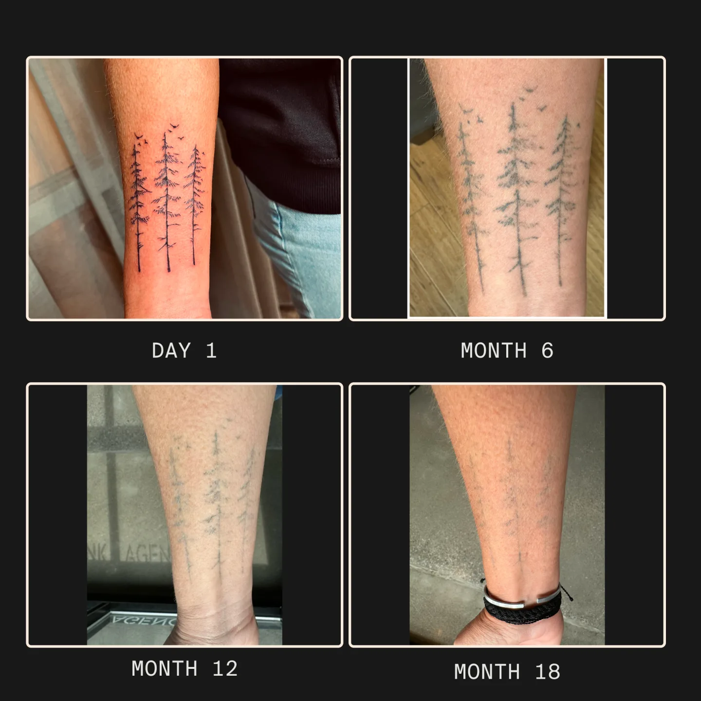 松(パインツリー)のエフェメラルタトゥーの退色経過(Day 1 → Month 18)